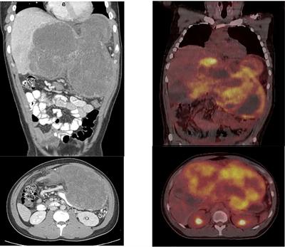 Case report: Multimodal neoadjuvant and adjuvant chemotherapy for hepatic undifferentiated embryonal sarcoma in a young adult